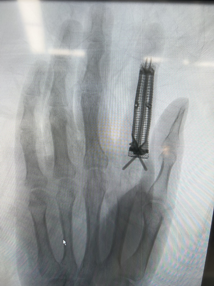 骨缺损不必「挖东墙补西墙」！深圳 27 岁男子手指骨缺损植入 3D 打印钛合金假体