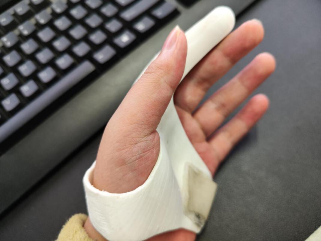 骨缺损不必「挖东墙补西墙」！深圳 27 岁男子手指骨缺损植入 3D 打印钛合金假体