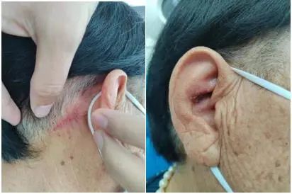 北京大学第三医院延安分院（延安市中医医院）耳鼻喉科祛除患者耳中「隐患」