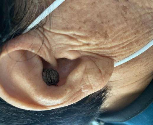 北京大学第三医院延安分院（延安市中医医院）耳鼻喉科祛除患者耳中「隐患」