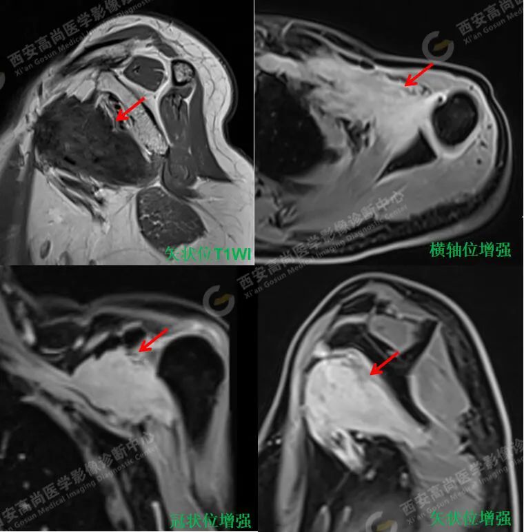 高尚病例：MRI 诊断肩部弹力纤维瘤一例
