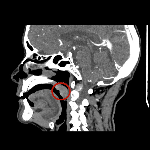 警惕这种癌症,可能一发现即是晚期!