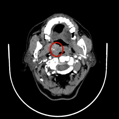 警惕这种癌症,可能一发现即是晚期!