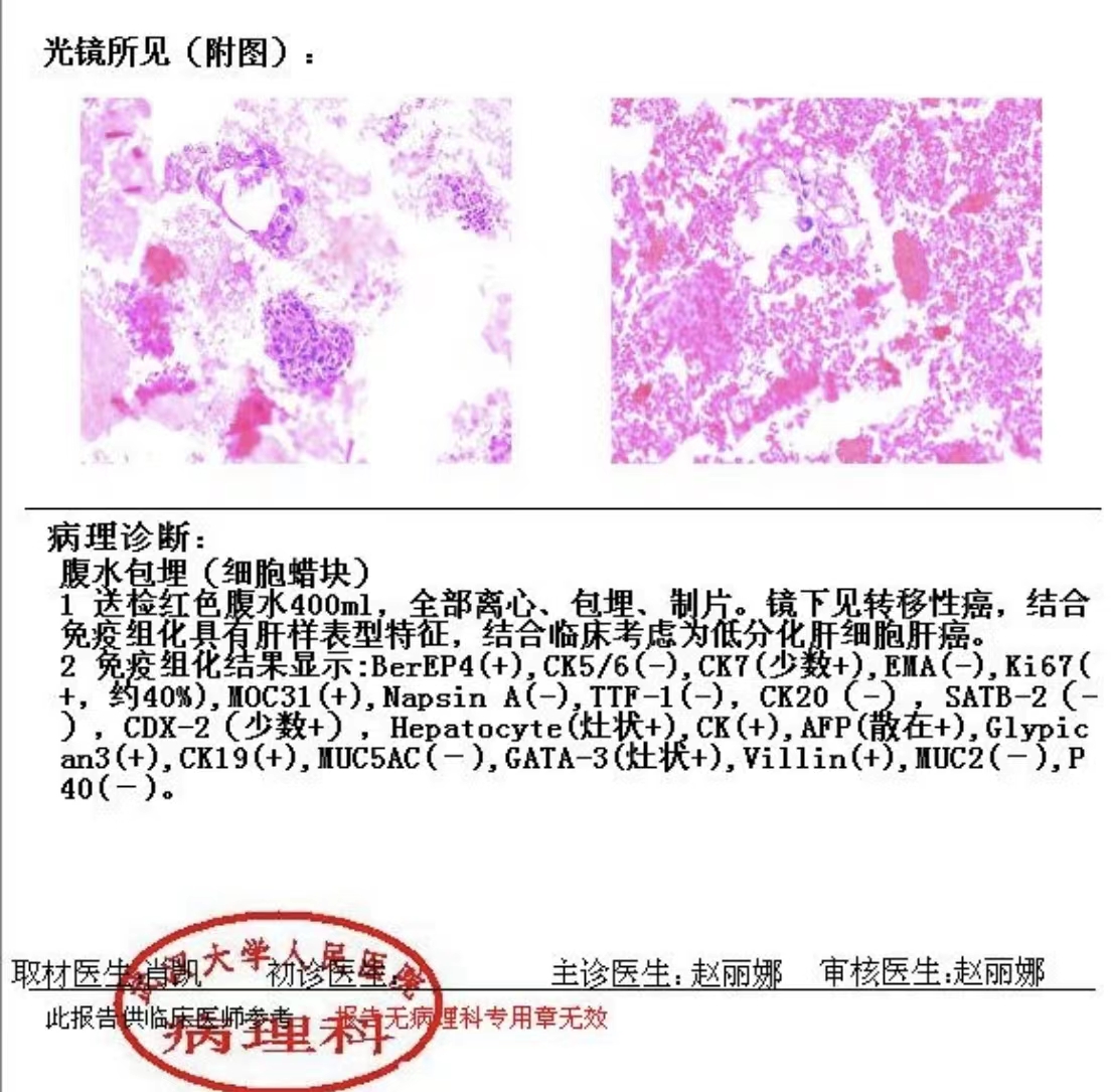 武汉大学人民医院病理科细胞蜡块技术助力从胸腹水中检出癌细胞
