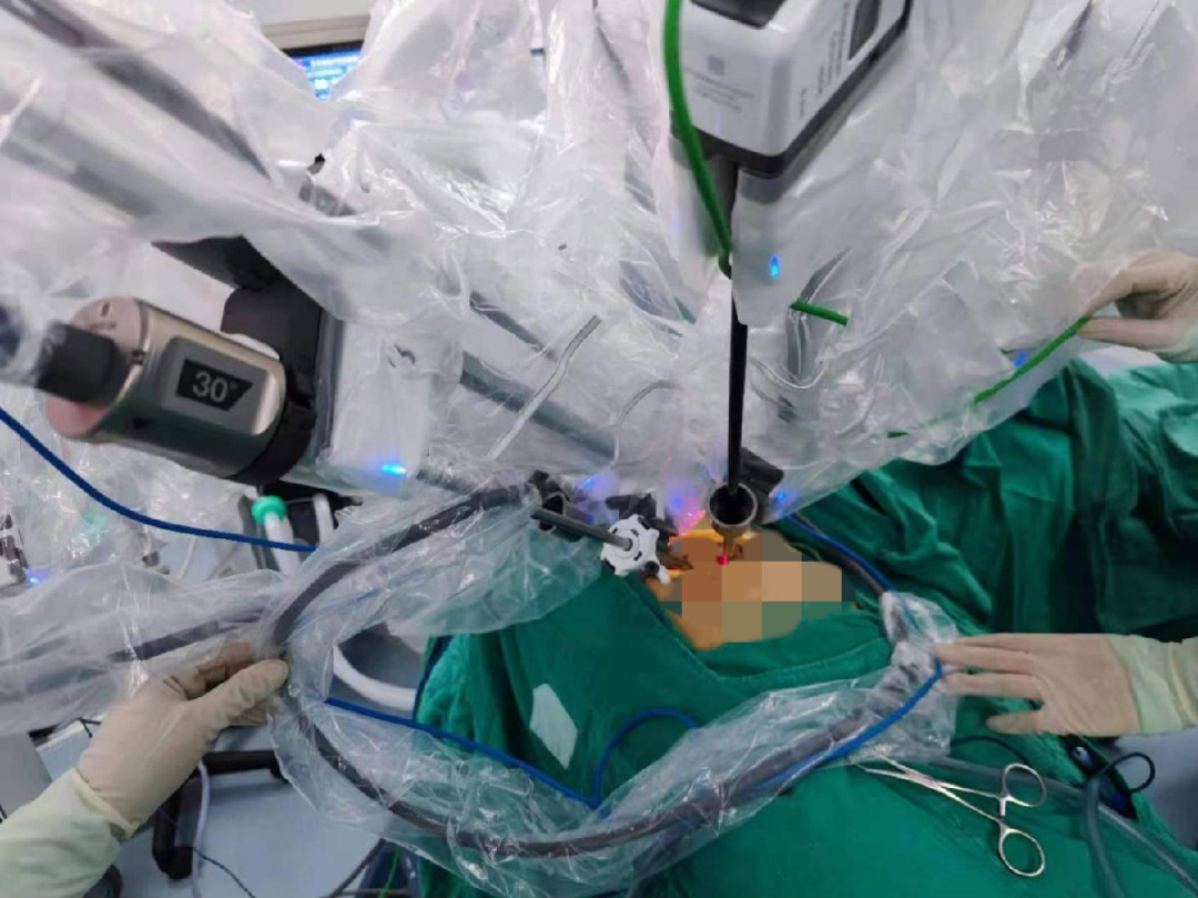 广西壮族自治区人民医院单孔达芬奇机器人手术为患者切除心包肿物