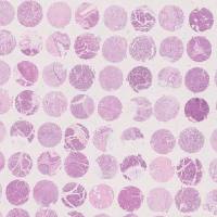 生存期胰腺癌组织芯片 92例