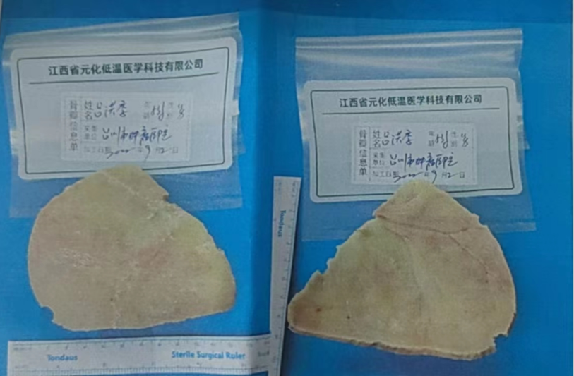【台肿故事】颅骨重生，台州市肿瘤医院成功开展自体颅骨修补术