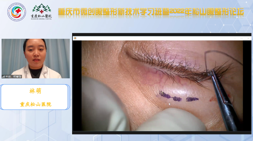 院士专家汇聚，线上超 6000 人！重庆市微创眼整形新技术学习班暨松山眼整形论坛顺利召开