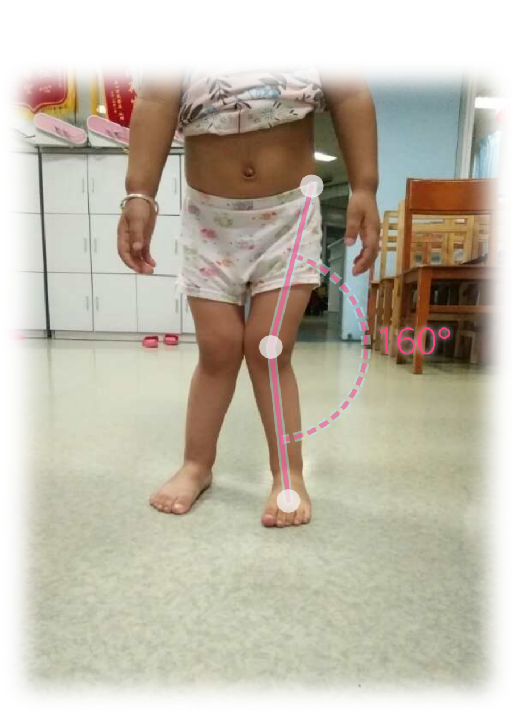 当心！不良行走姿势影响发育，广西壮族自治区人民医院公益课堂助孩子健康成长