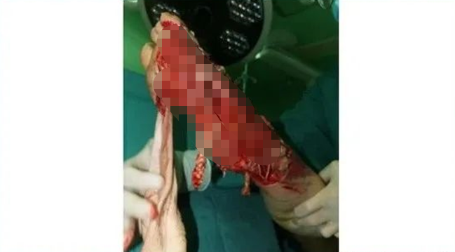 16 岁花季少女严重脚脱套伤，徐州仁慈医院救人保肢