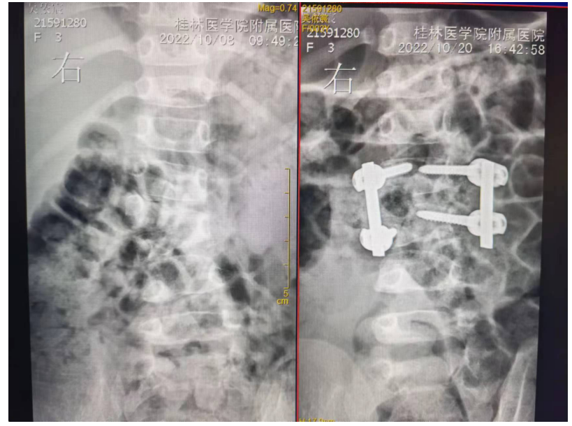 桂林医学院附属医院脊柱外科成功为 3 岁患儿进行脊柱矫形