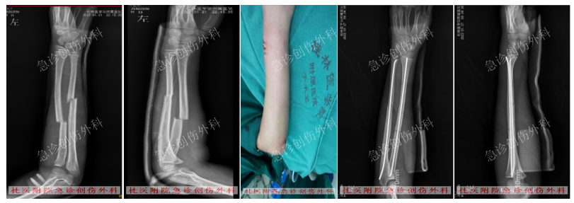 桂林医学院附属医院急诊创伤外科用「心」技术解小儿骨折「愁」问题