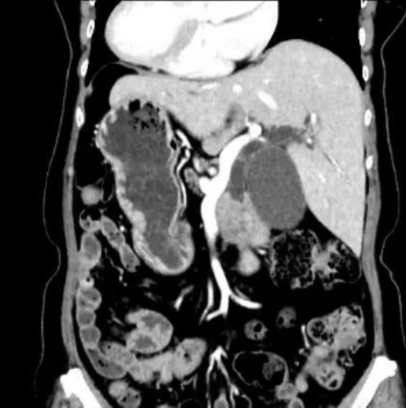 罕见！「小黄人」竟是「镜像人」，肝胆胰外科医生逆行挑战高难度手术成功