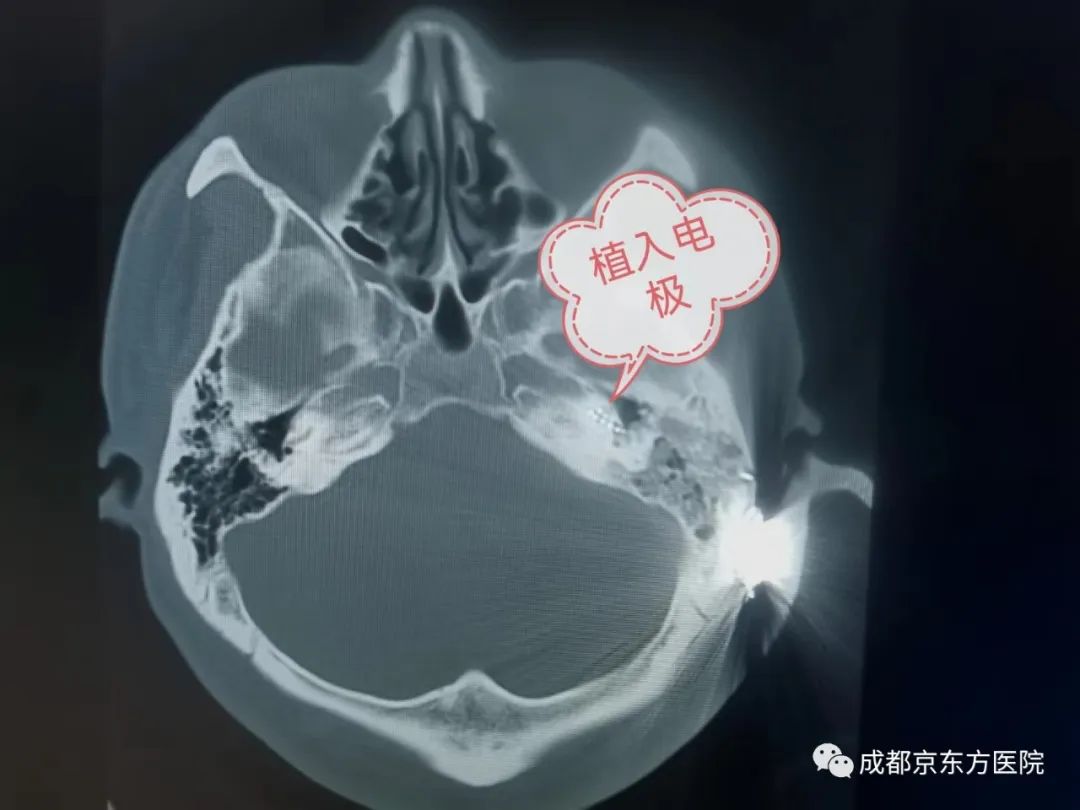 人工耳蜗植入让他重返有声世界
