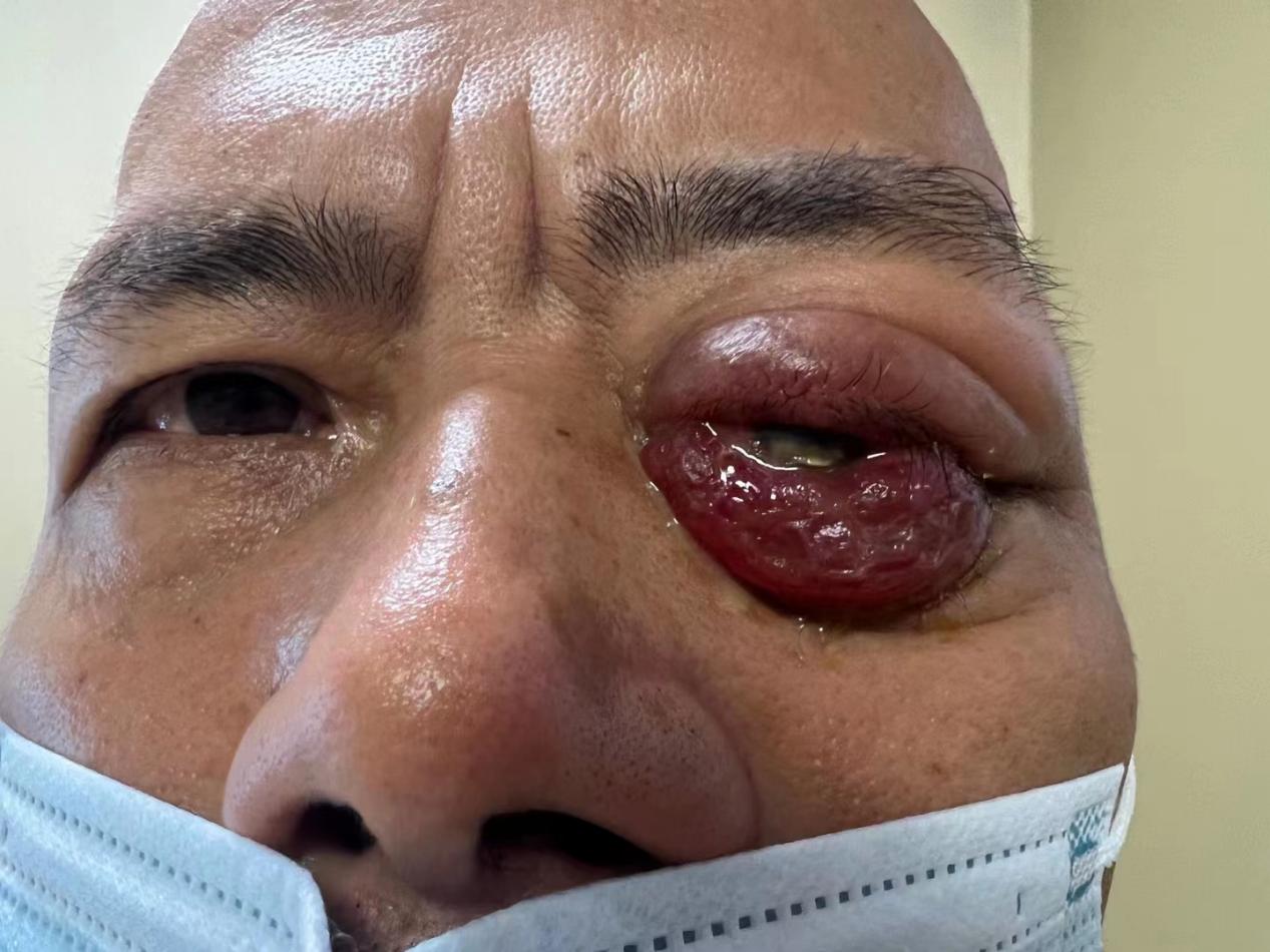 眼眶肿物拖了 10 年发生恶变，福州爱尔眼科医生成功手术「拆弹」