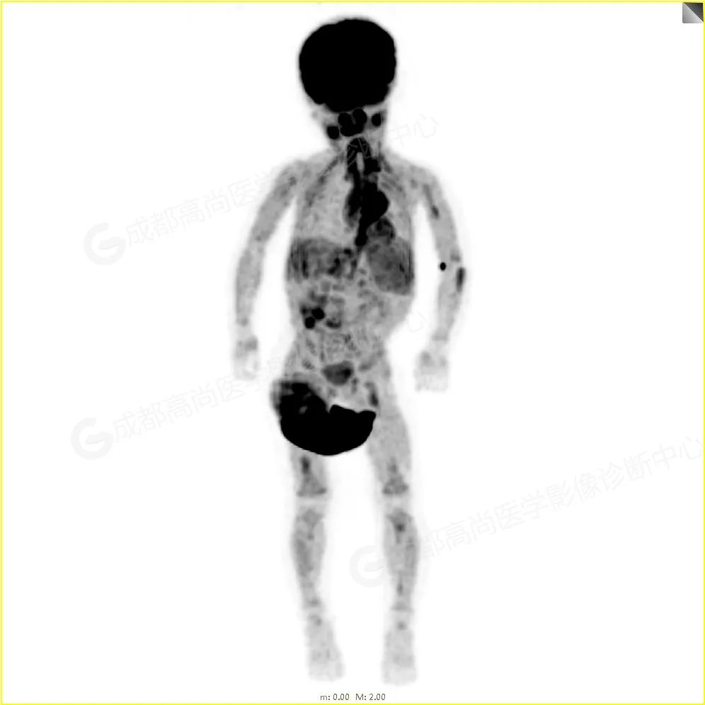 高尚病例：1 岁男孩因发热被查出肺部阴影，PET/CT 诊断纵隔神经母细胞 