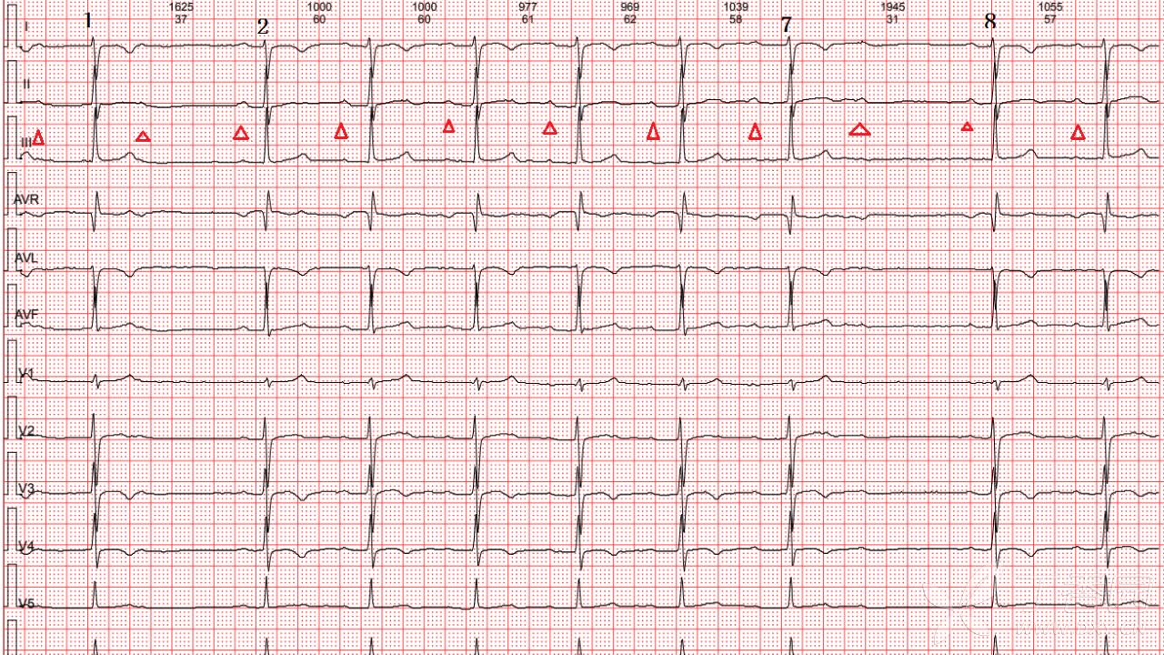 心脏漏搏的心电图图片