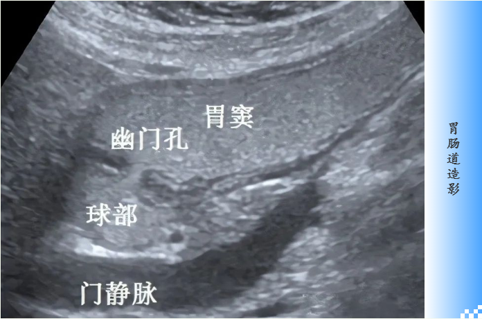 硫酸钡如何当选X射线造影检查的诊断用药？