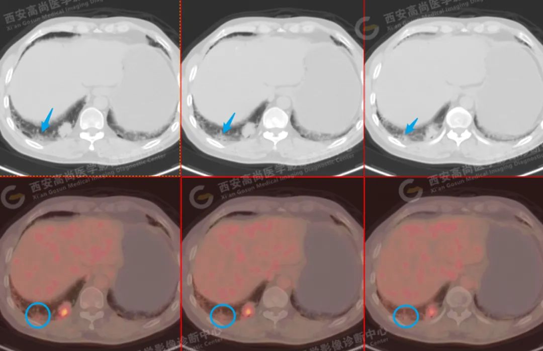 高尚病例 PET/CT 病例：两枚肺结节两种病理类型，科普肺腺鳞癌