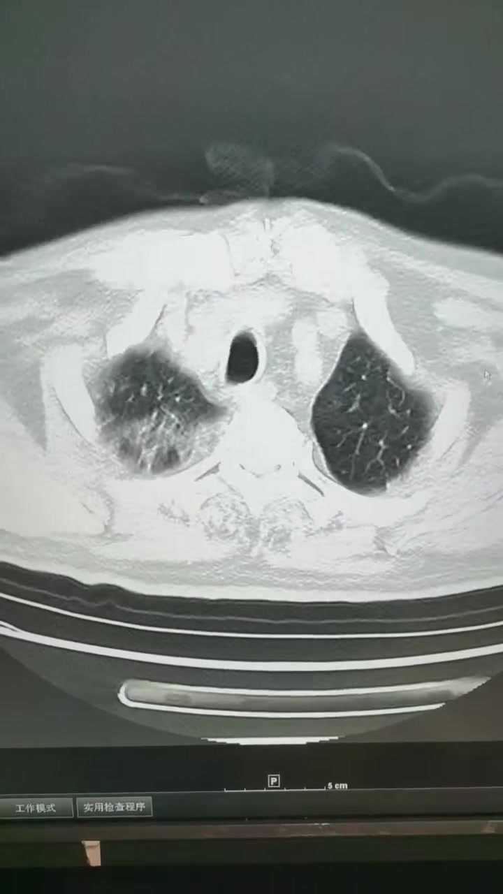 得新冠的肺是啥样图片图片