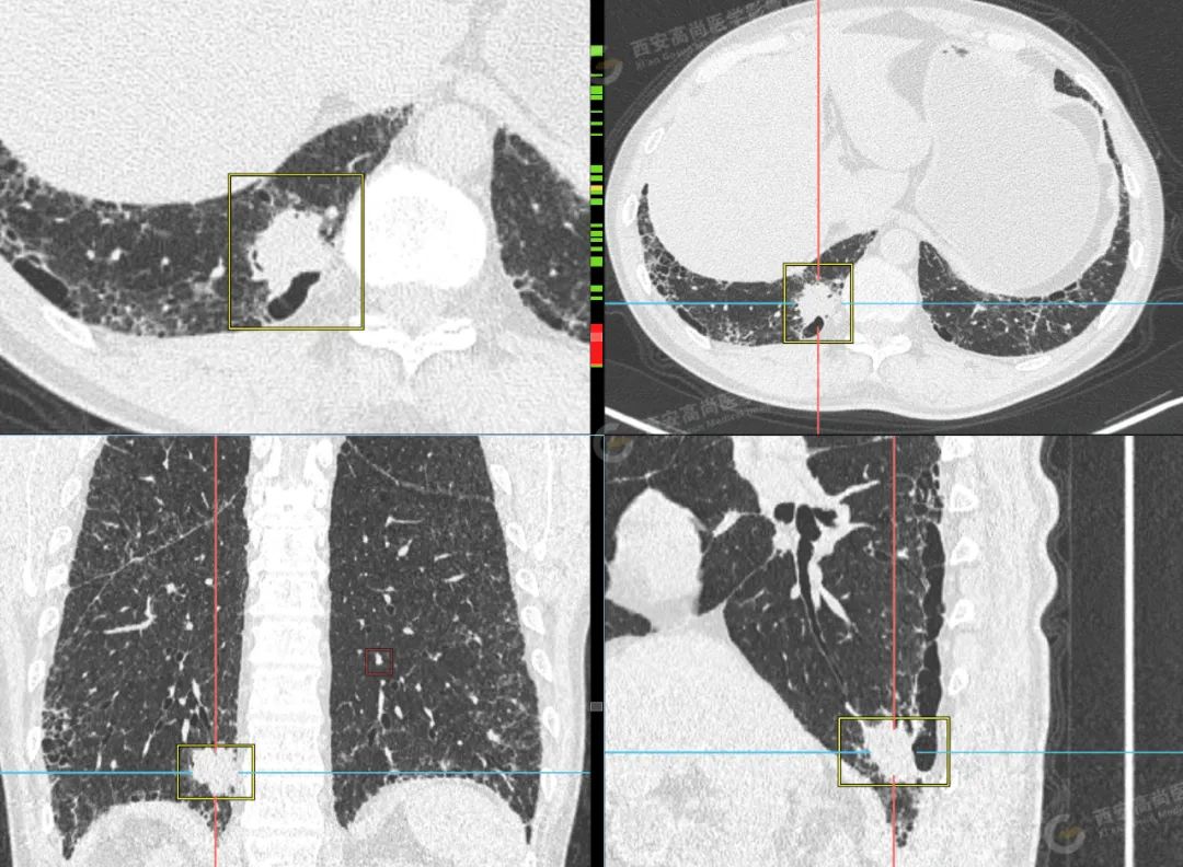 高尚病例 PET/CT 病例：两枚肺结节两种病理类型，科普肺腺鳞癌