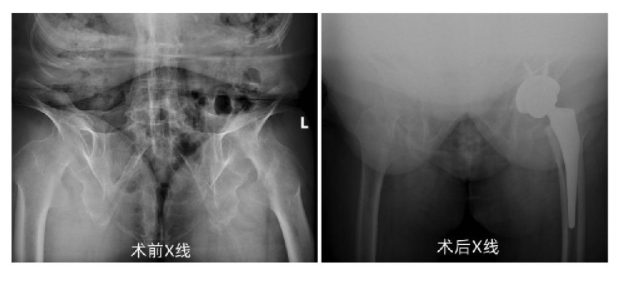 被强直性脊柱炎折磨 20 年 | 广西壮族自治区人民医院为六旬老人实施人工全髋关节置换术治疗