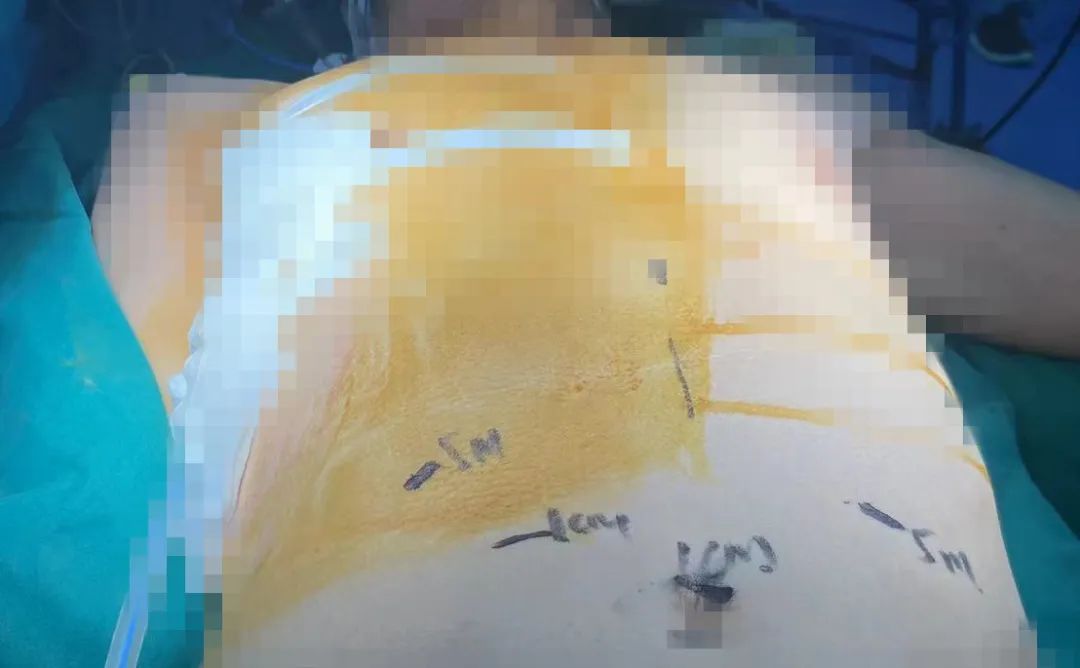 「镜」益求精——宁城县中心医院心胸外科再次完成一例胸腹腔镜联合下食管癌切除术