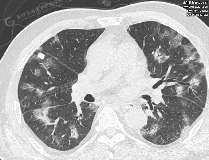 普通型新冠感染累及肺早期影像学表现