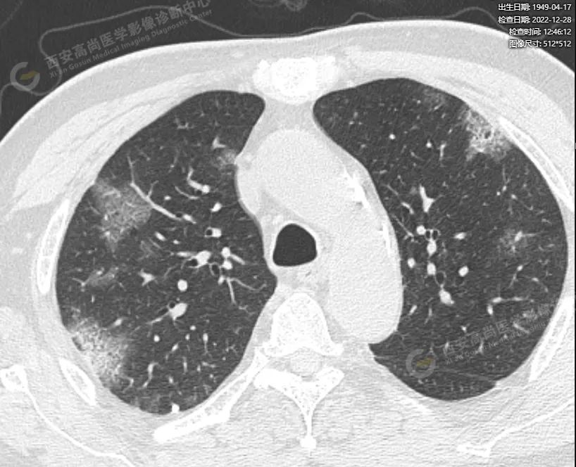 普通型新冠感染累及肺早期影像学表现