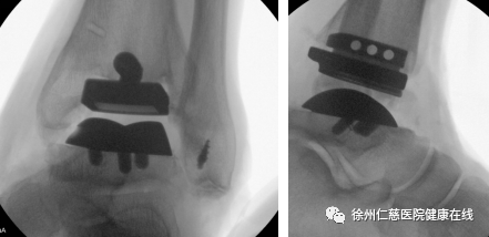 徐州仁慈医院成功完成一例数字化人工全踝关节置换手术