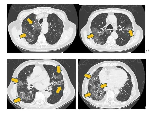 防止「白肺」，你可能需要做一次 CT 检查了！