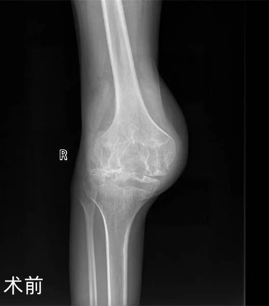 广西壮族自治区人民医院为血友病患者置换膝关节解决行走难题