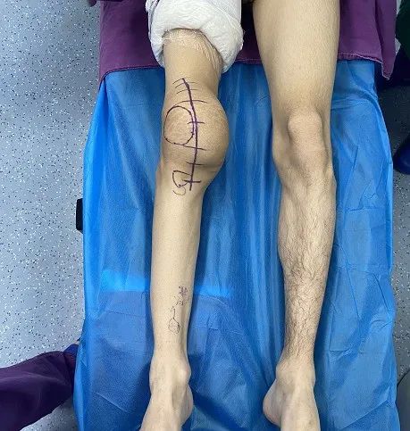广西壮族自治区人民医院为血友病患者置换膝关节解决行走难题