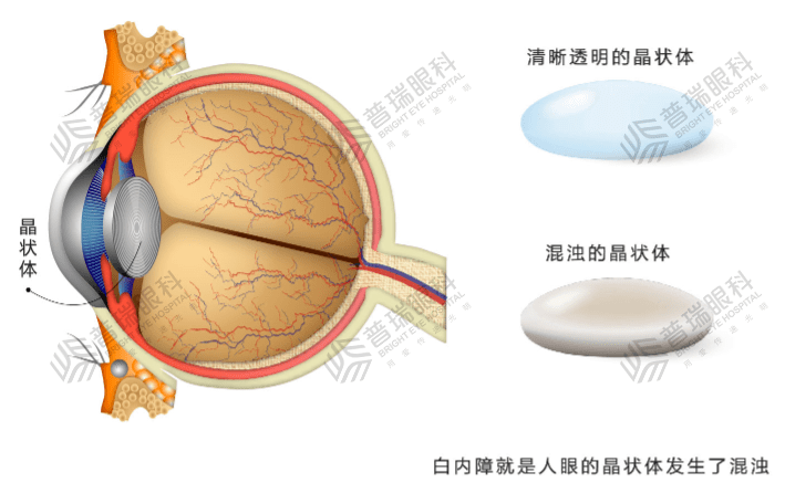 武汉普瑞眼科医院科普丨白内障合并青光眼、眼底病等其他眼病，该怎么办？