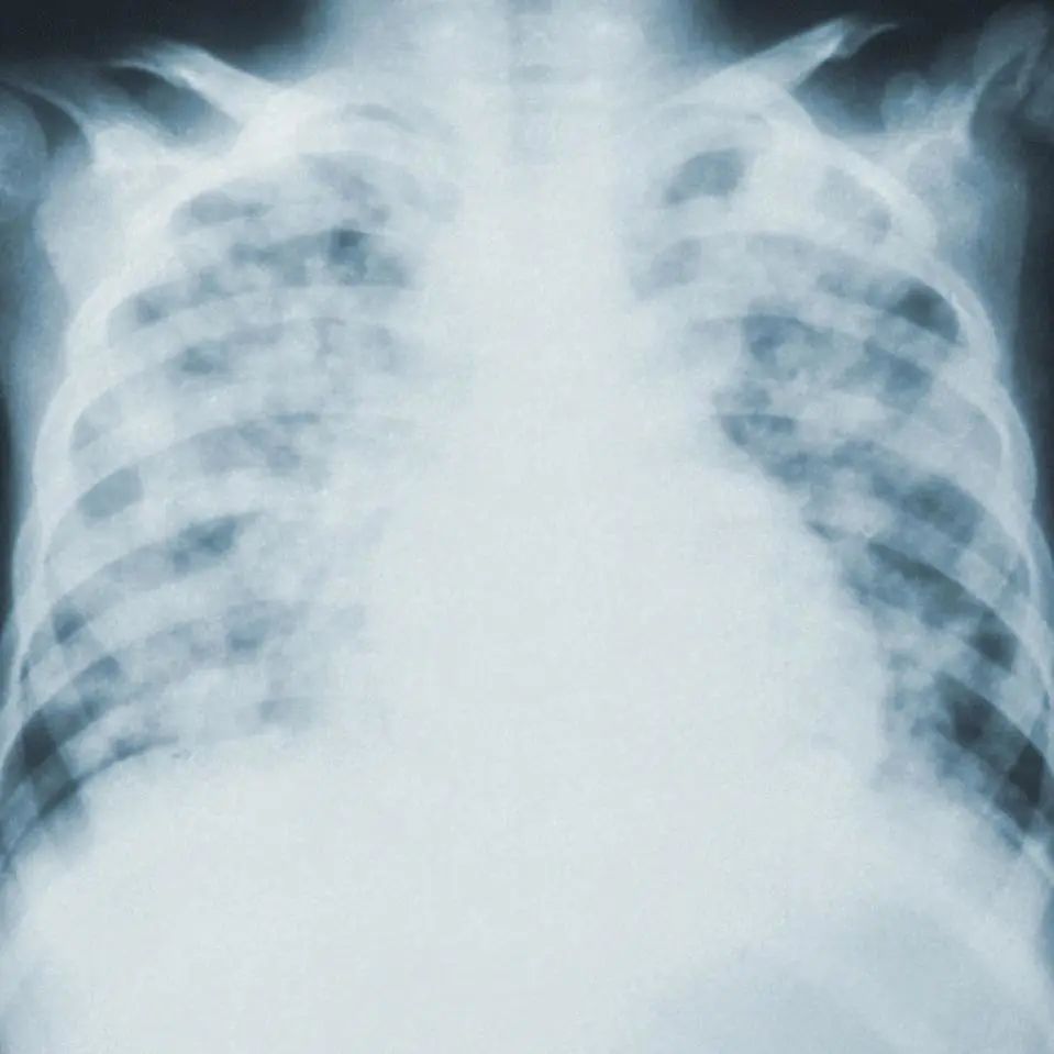 「白肺」是什么？阳了之后哪些情况要拍 CT？