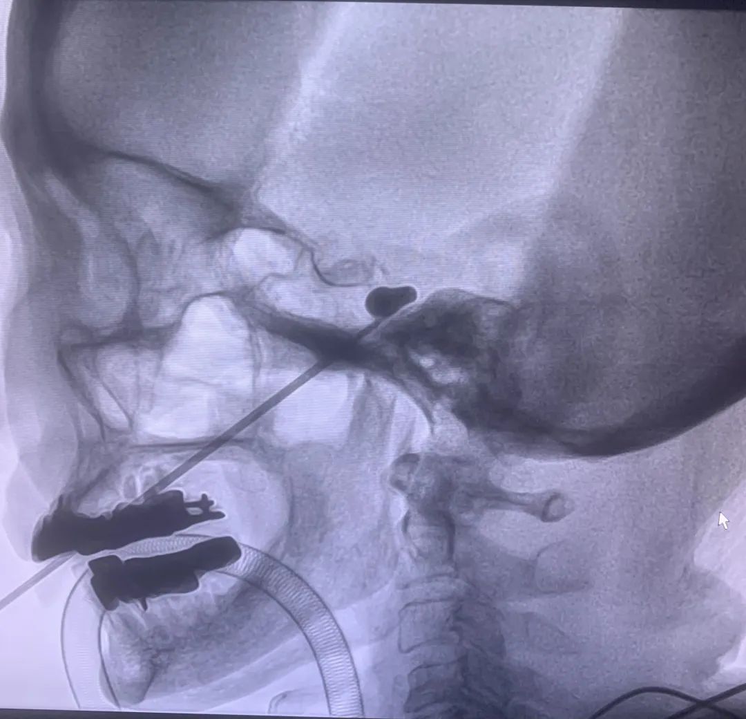 「天下第一痛」缠上 90 岁老人，医生：来一针就好了