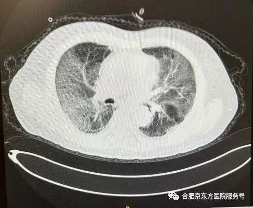 八旬老伯不高烧不咳嗽，一查却「白肺」，家有老人一定要注意