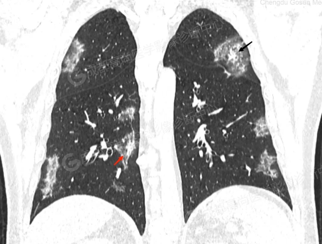 高尚病例：患者持续干咳乏力，CT 检出新冠病毒感染肺部 1 例