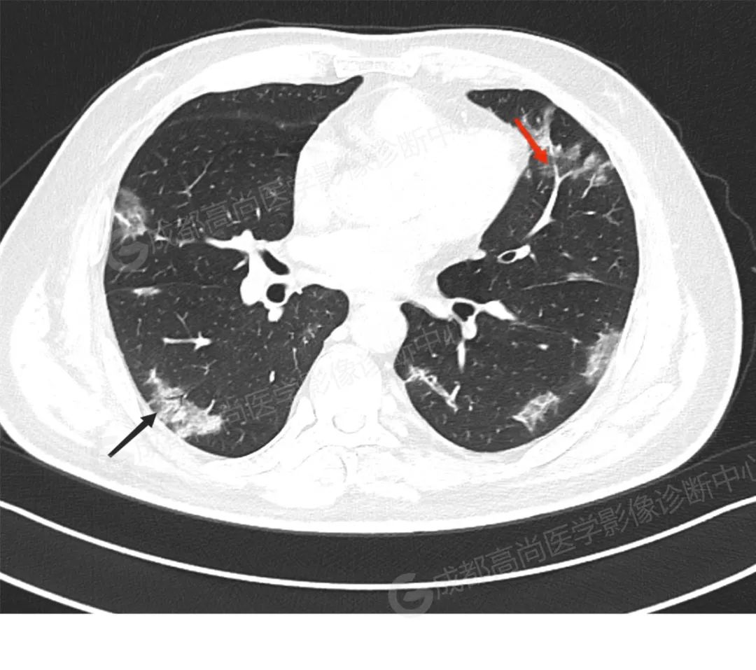 高尚病例：患者持续干咳乏力，CT 检出新冠病毒感染肺部 1 例