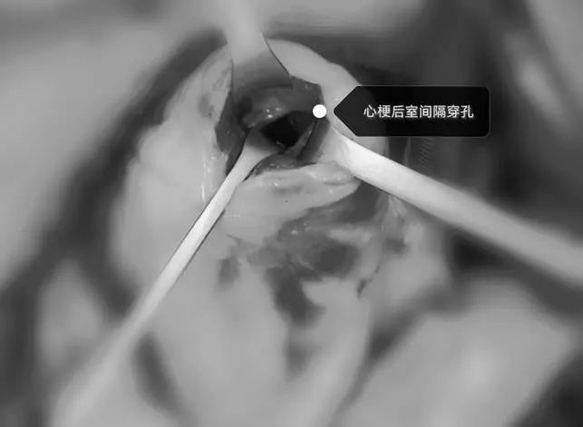 淮安市第一人民医院成功救治急性心梗合并室间隔穿孔高危患者