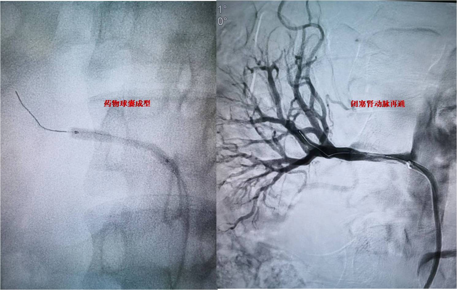 西安交通大学第一附属医院血管外科杨林团队成功救治未成年肾动脉闭塞患者