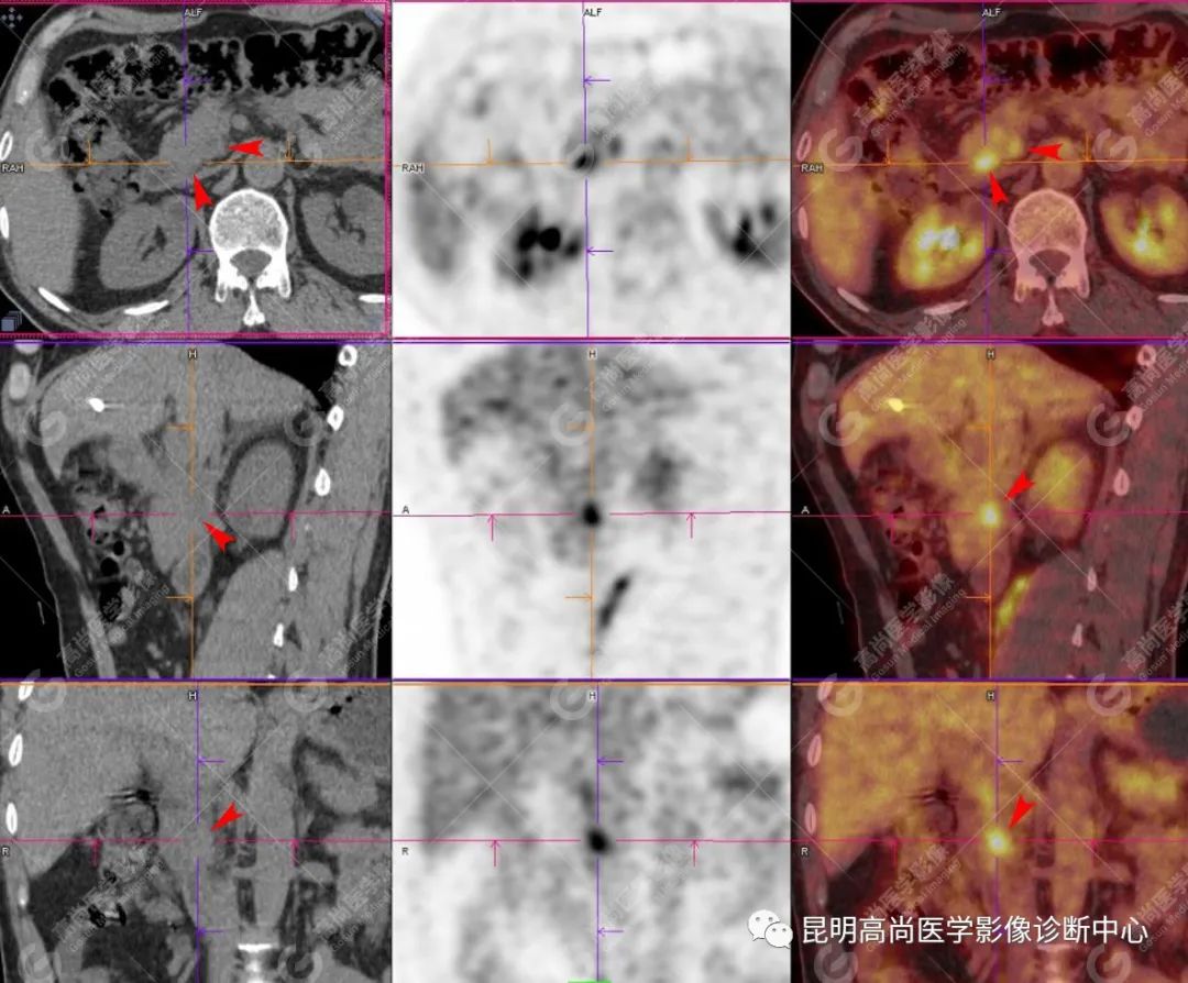 高尚病例：胰腺导管腺癌一例