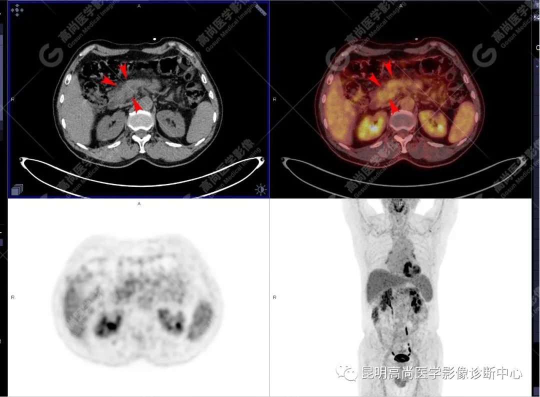 高尚病例：胰腺导管腺癌一例