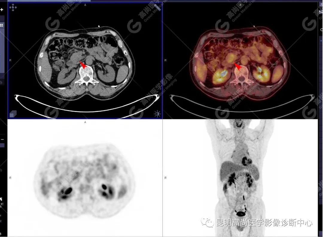 高尚病例：胰腺导管腺癌一例