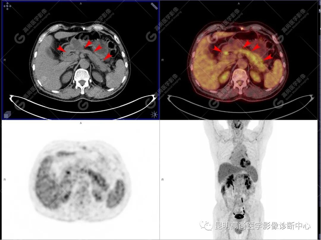 高尚病例：胰腺导管腺癌一例