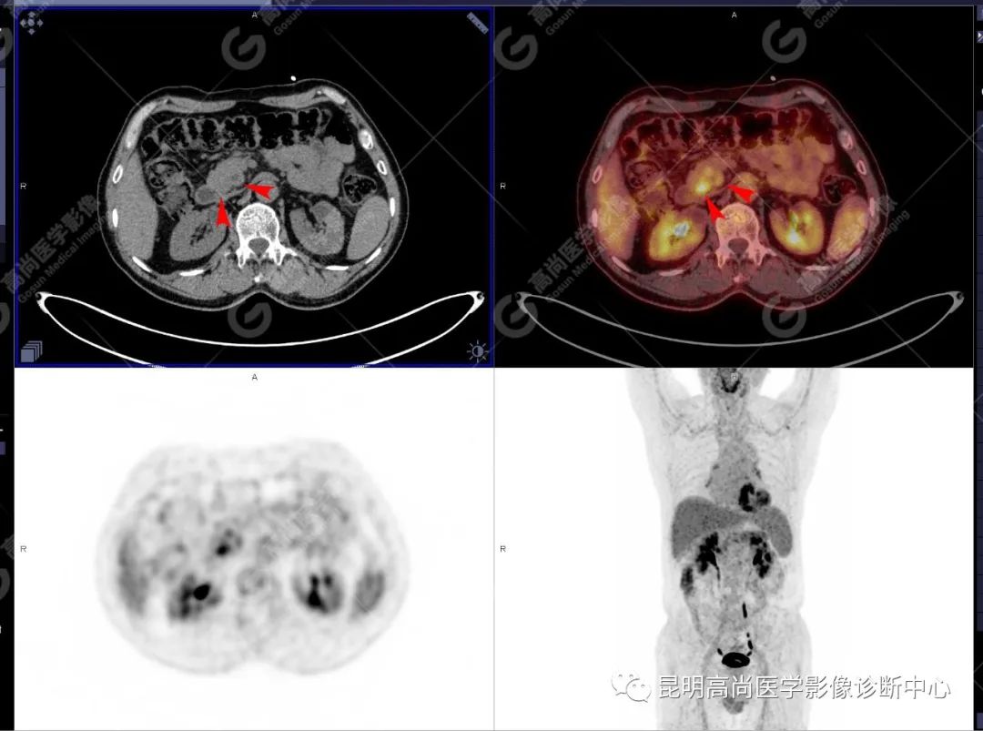 高尚病例：胰腺导管腺癌一例