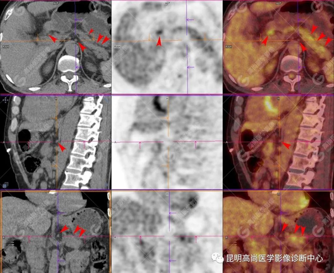 高尚病例：胰腺导管腺癌一例