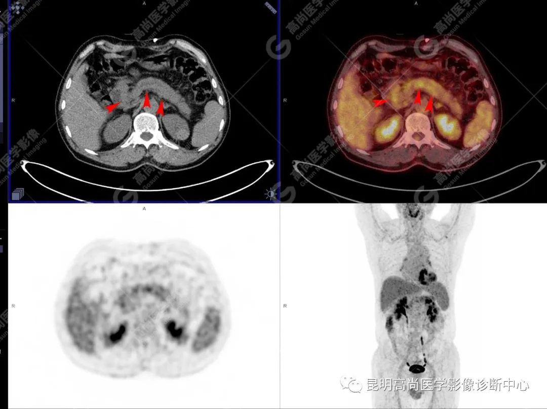 高尚病例：胰腺导管腺癌一例