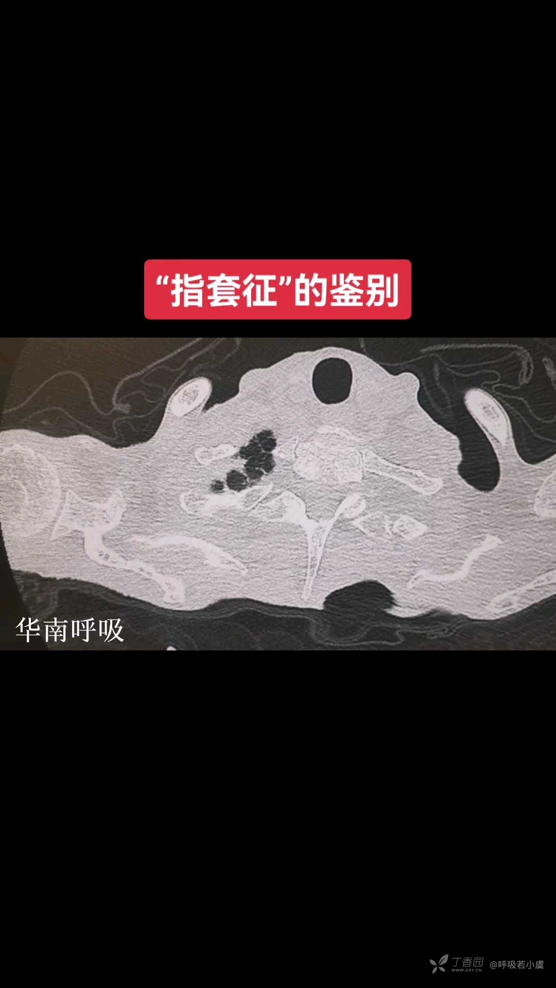 指套征的鉴别思路