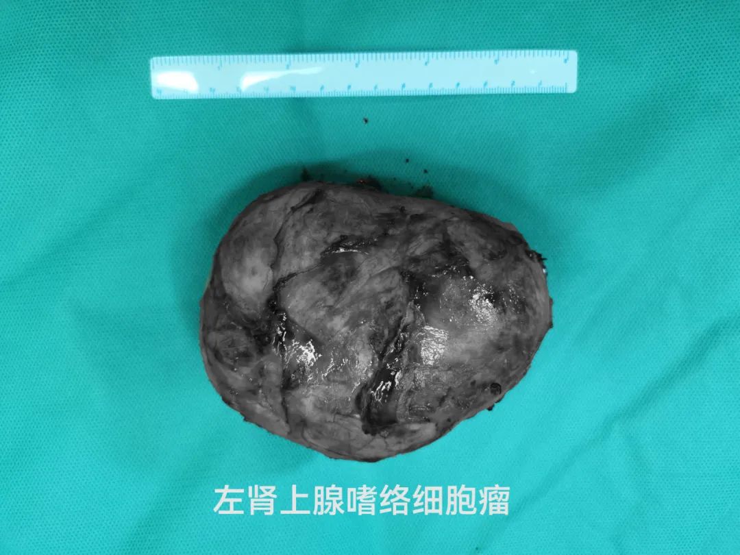 这颗「一碰就炸」的肿瘤，被他们顺利切除……